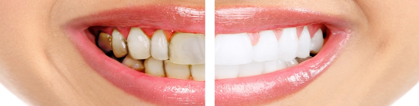 teeth whitening